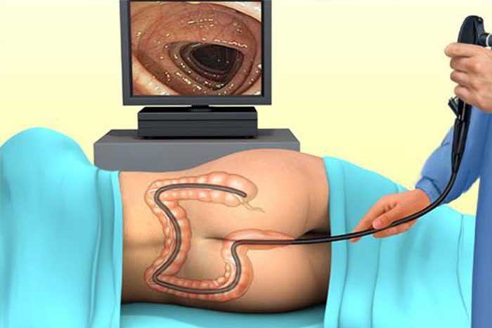 colonoscopy
